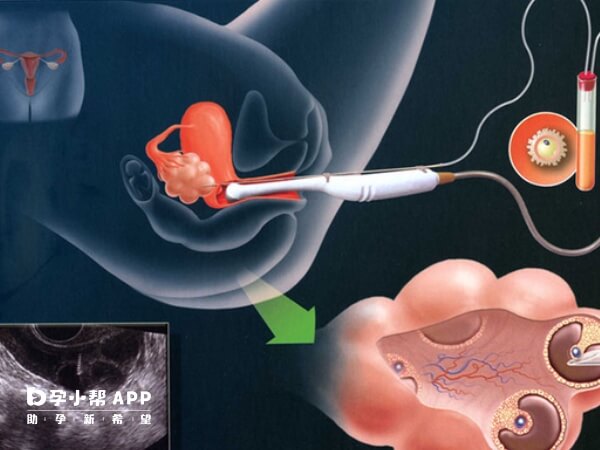 人工授精与受精都是助孕术