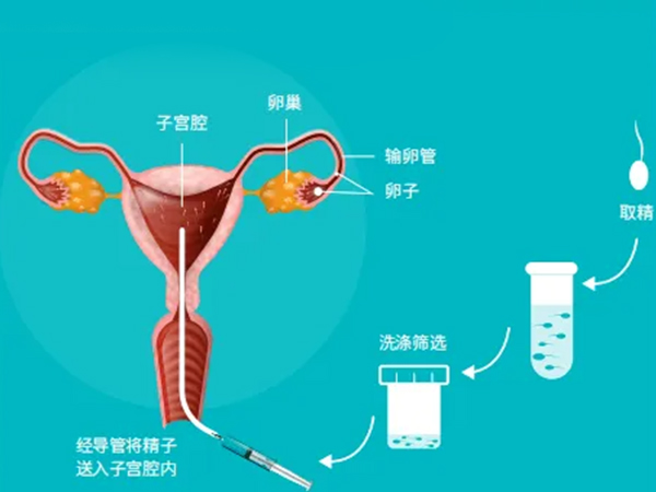 人工授精操作过程是比较简单的