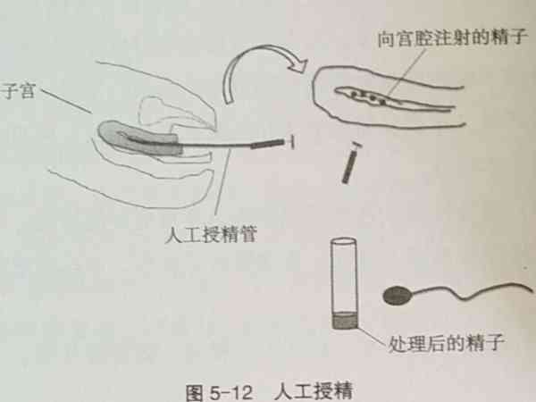 人工授精步骤图示