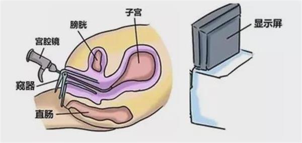 做宫腔镜比较痛苦